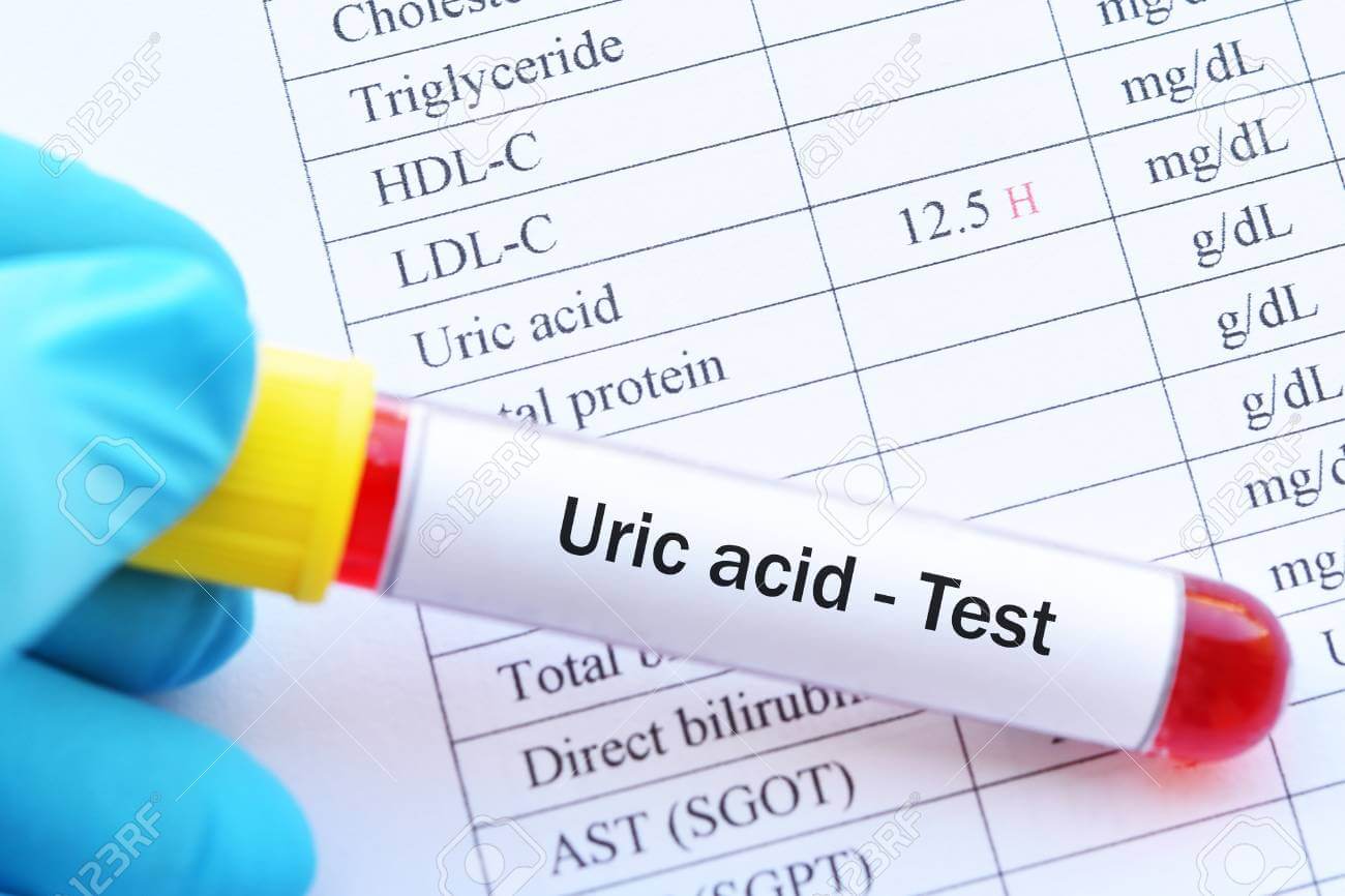 ما هو تحليل uric acid ،وهل المعدل مرتفع ام منخفض ؟ - تحاليلي